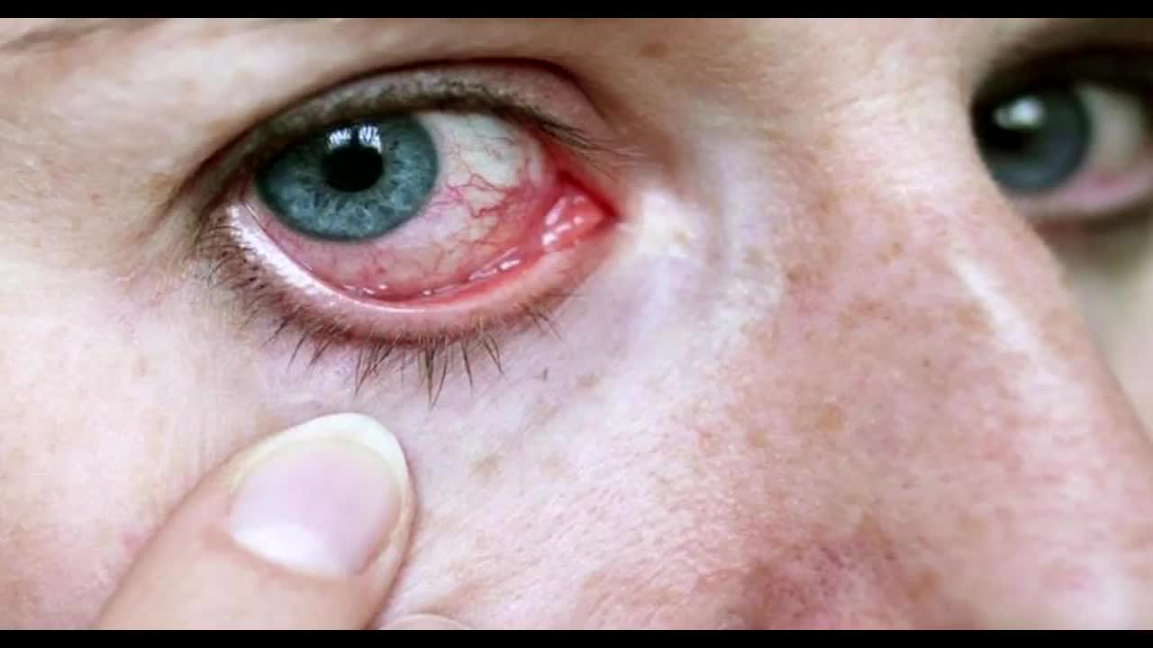 Göz allergiyasını necə azaltmalı? – Üsullar
