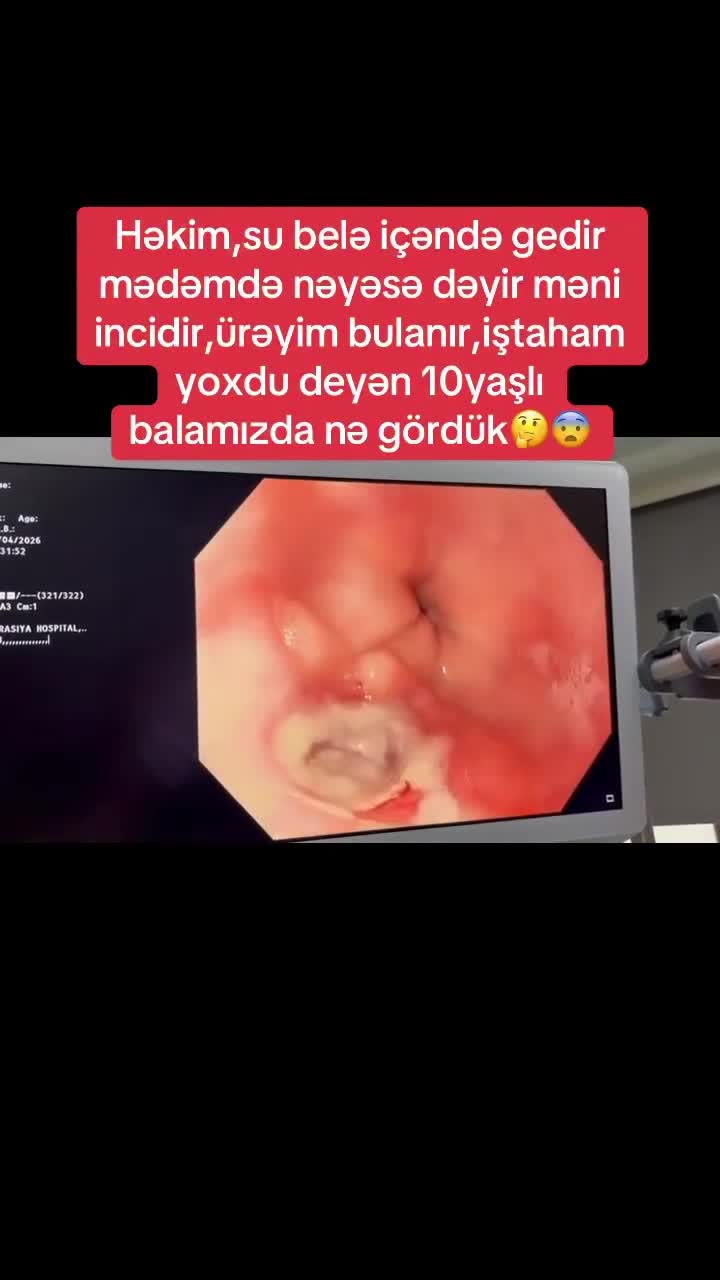 Coca-Cola və çips yeyən 10 yaşlı uşağın mədəsi bu hala düşdü 